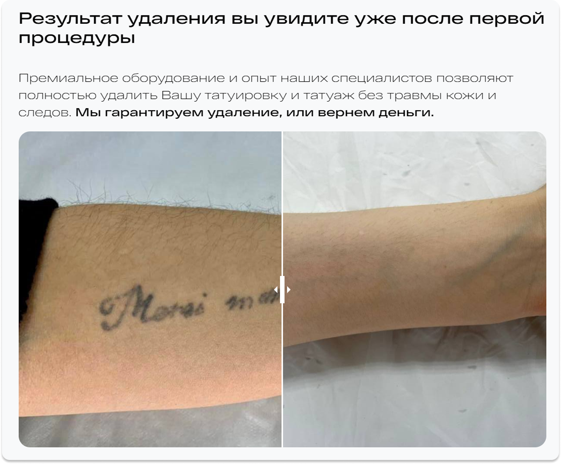 Блок «до и после» на сайте ET.LASER: фотография удалённой надписи на руке с плавным переключением между состояниями кожи
